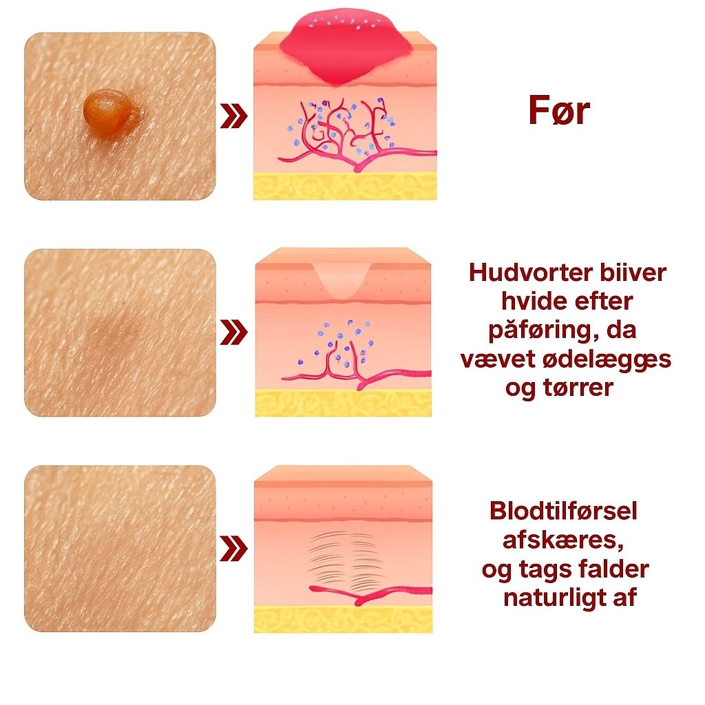 DermaGlow™ | Fjerner vorter og alderspletter – smertefrit inden for 3 dage!