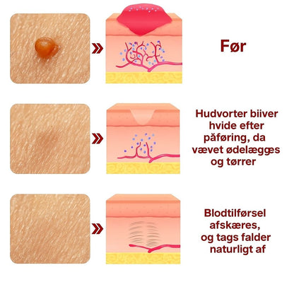 DermaGlow™ | Fjerner vorter og alderspletter – smertefrit inden for 3 dage!