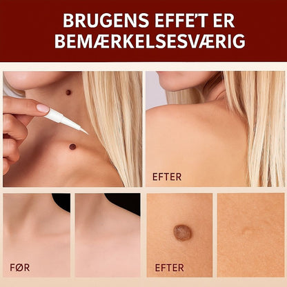 DermaGlow™ | Fjerner vorter og alderspletter – smertefrit inden for 3 dage!