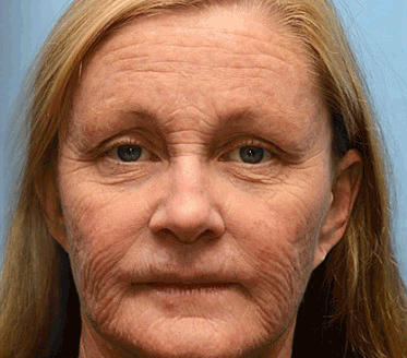 RynkeVæk™ | Botox Rynkefjernende Creme