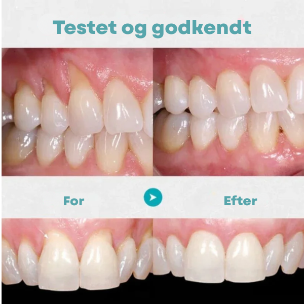 GumInstant™ - Ikke mere tilbagetrukket tandkød efter kun 3 dage!