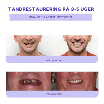 RefinaTand™ | Fixer tænder – giver tryghed