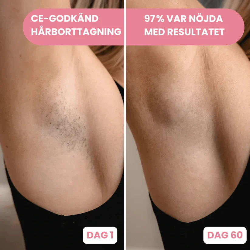 GlowLuxe™ IPL Laser – den smertefri løsning mod uønsket hårvækst og vejen til varig glat hud