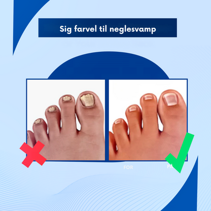 PureNail™ - Slip af med neglesvamp og få din selvtillid tilbage.