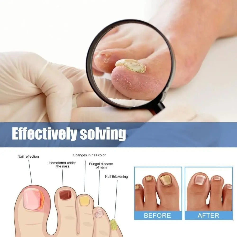 ClearNail™ - Antibakteriel Svampepatch Og Neglepleje Pakk