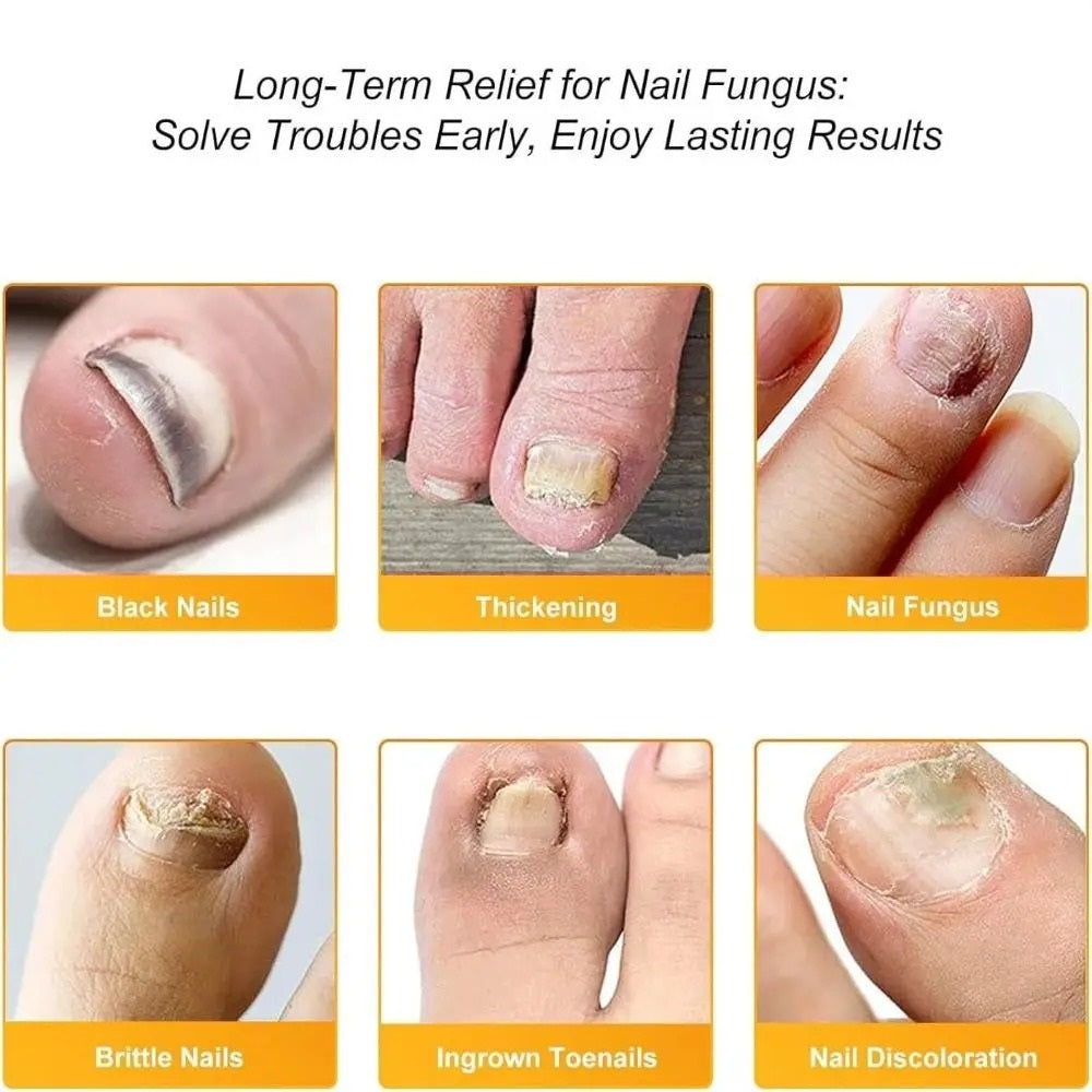 ClearNail™ - Antibakteriel Svampepatch Og Neglepleje Pakk