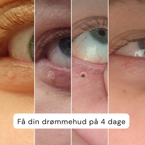 SkinPure™ Komplett Set - Nie wieder Hautanhängsel