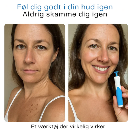 SkinPure™ Komplett Set - Nie wieder Hautanhängsel