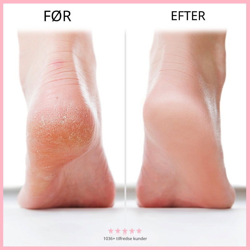 FootPure™ - Farvel, sprukken hud – goddag, bløde fødder!