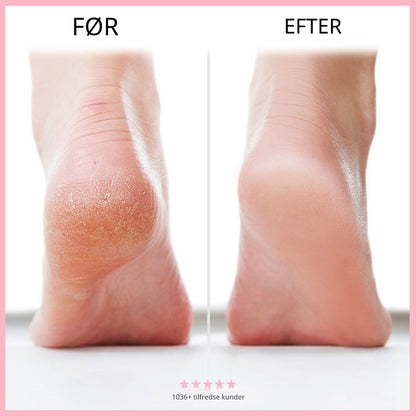 FootPure™ - Farvel, sprukken hud – goddag, bløde fødder!